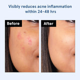 BeBodywise Hydrocolloid Acne Pimple Patch - 24 pcs