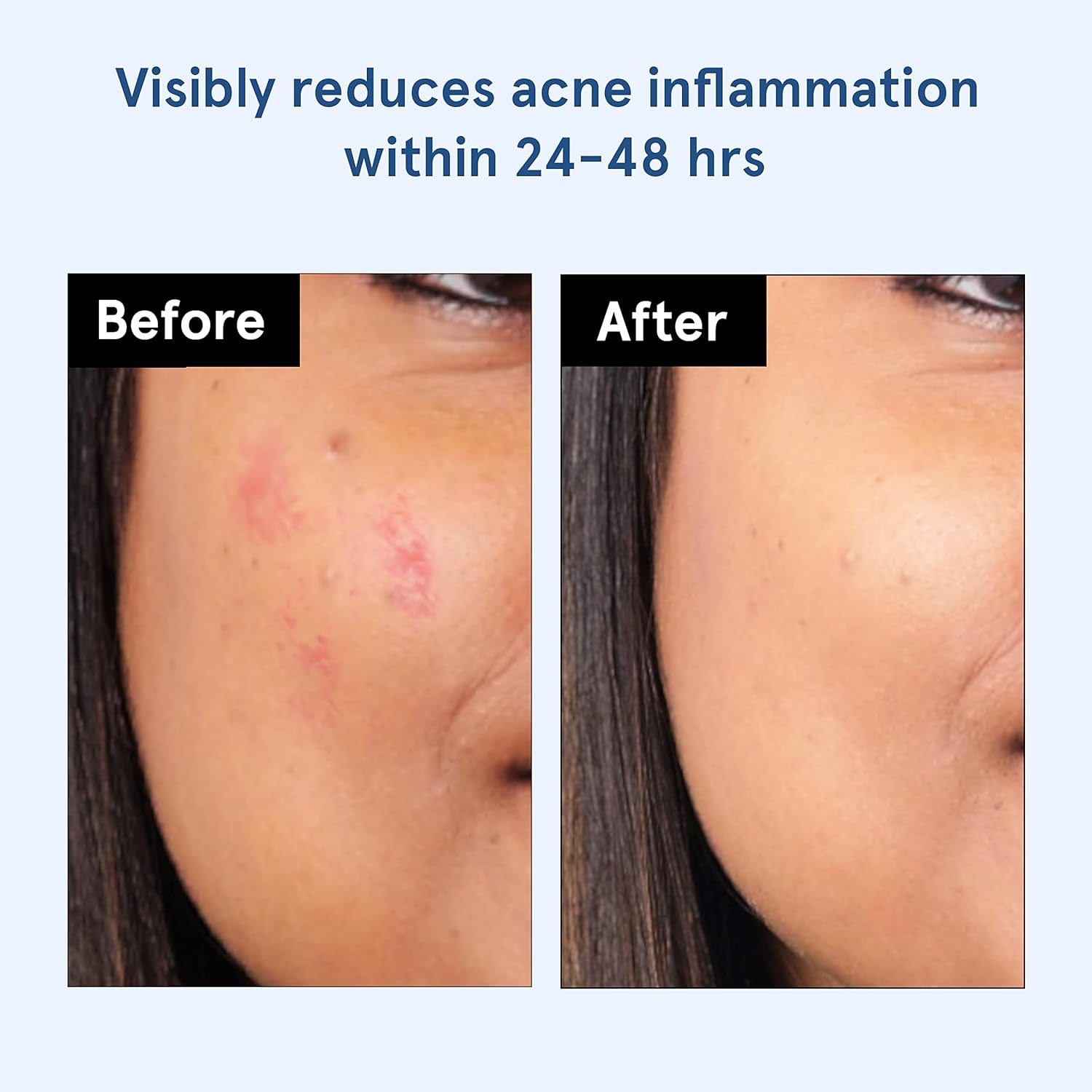BeBodywise Hydrocolloid Acne Pimple Patch - 24 pcs
